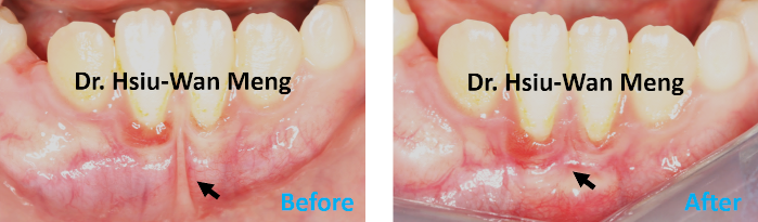 Frenectomy