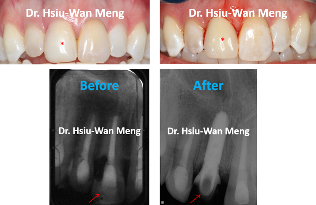 immediate implant placement