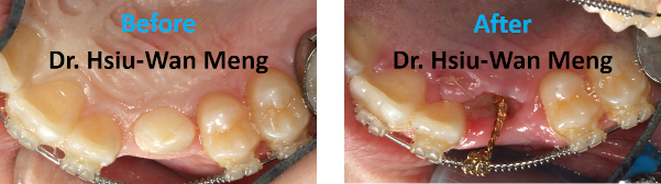 Impacted Tooth Expose And Bond 1