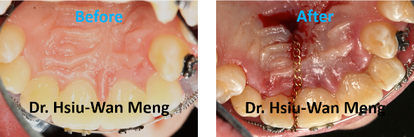 Impacted Tooth Expose And Bond 2