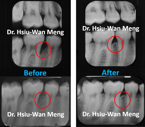 Periodontal Regeneration 1