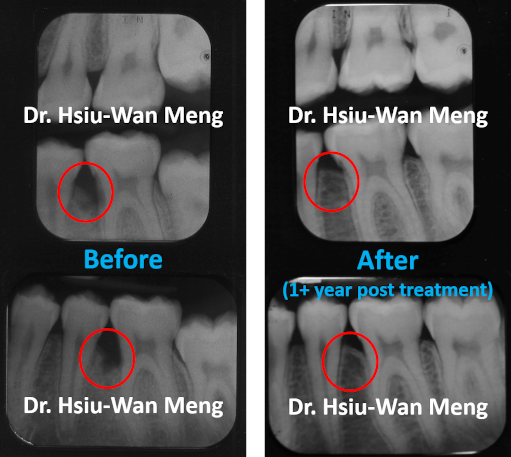 Periodontal Regeneration 2