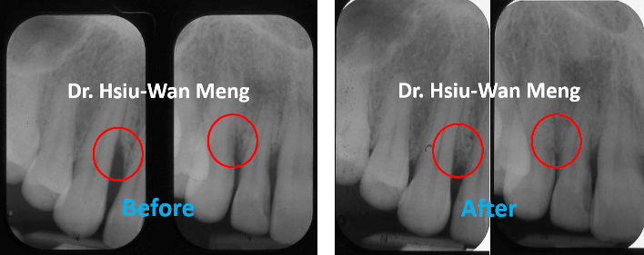 Periodontal Regeneration 3