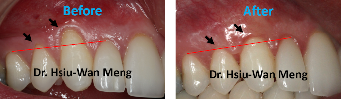 Soft Tissue Grafting 1