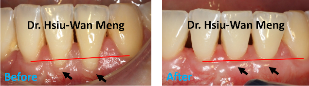 Soft Tissue Grafting 2