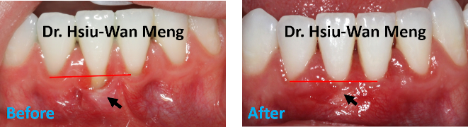 Soft Tissue Grafting 3