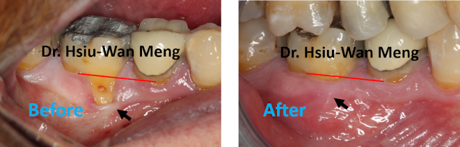 Soft Tissue Grafting 4