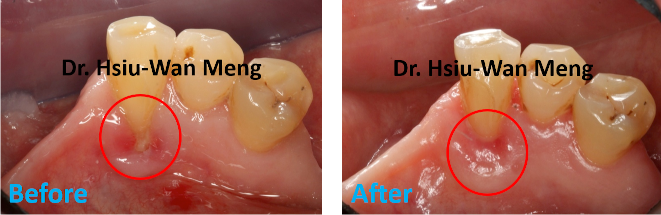 Soft Tissue Grafting 5