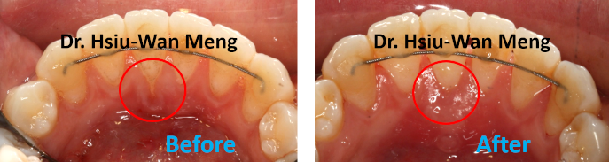 Soft Tissue Grafting 6