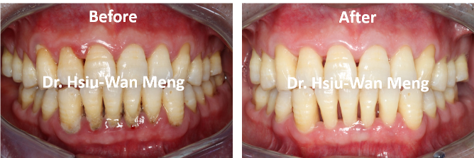 Treatment of Periodontitis