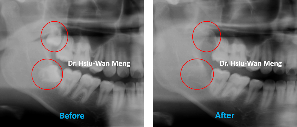 Wisdom Teeth Extraction 1