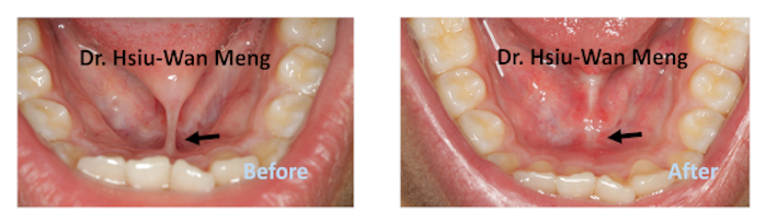 frenectomy 2