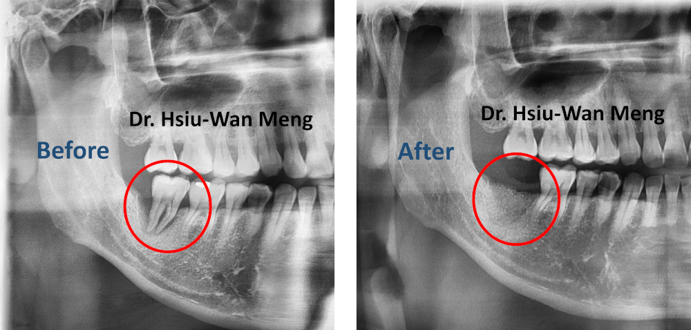 Extraction and Socket Bone Grafting 1