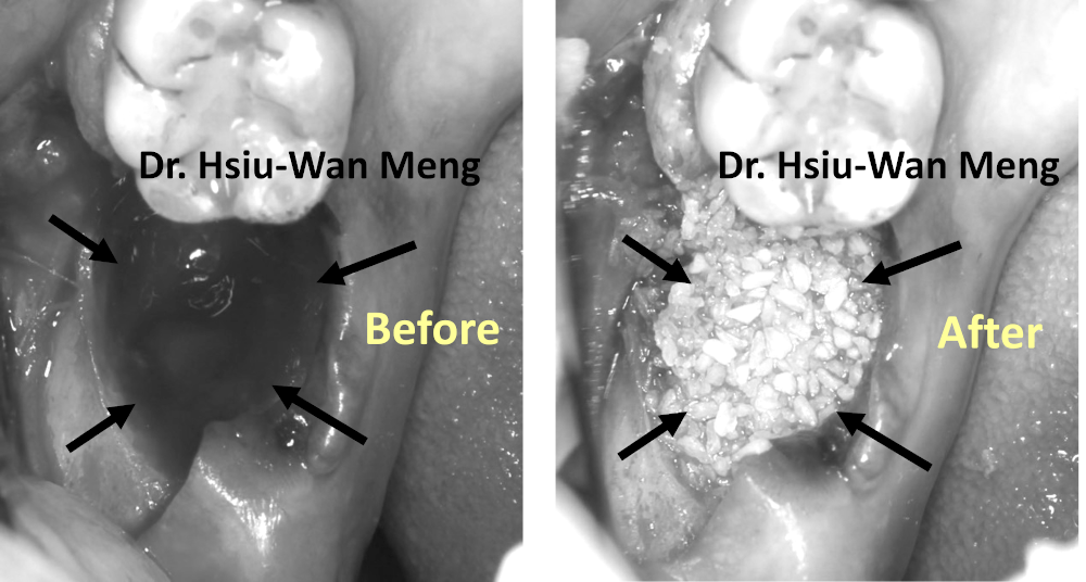 Extraction and Socket Bone Grafting 2