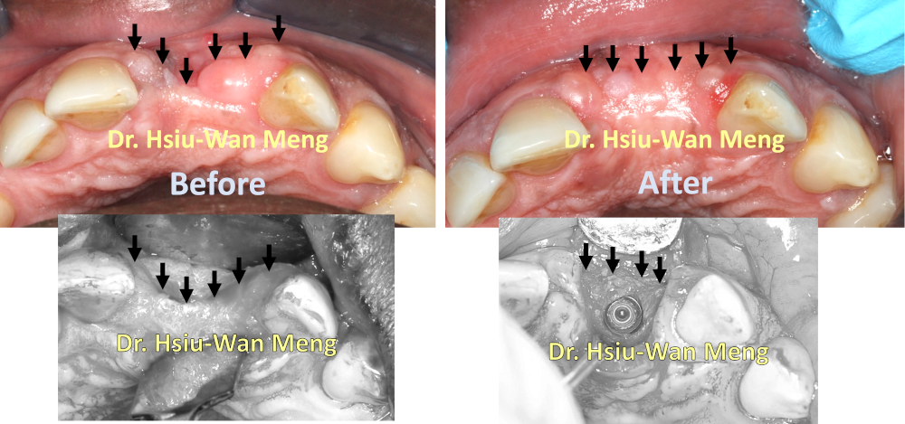 Jaw Bone Grafting