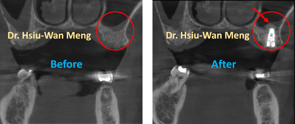 Sinus Bone Grafting 1