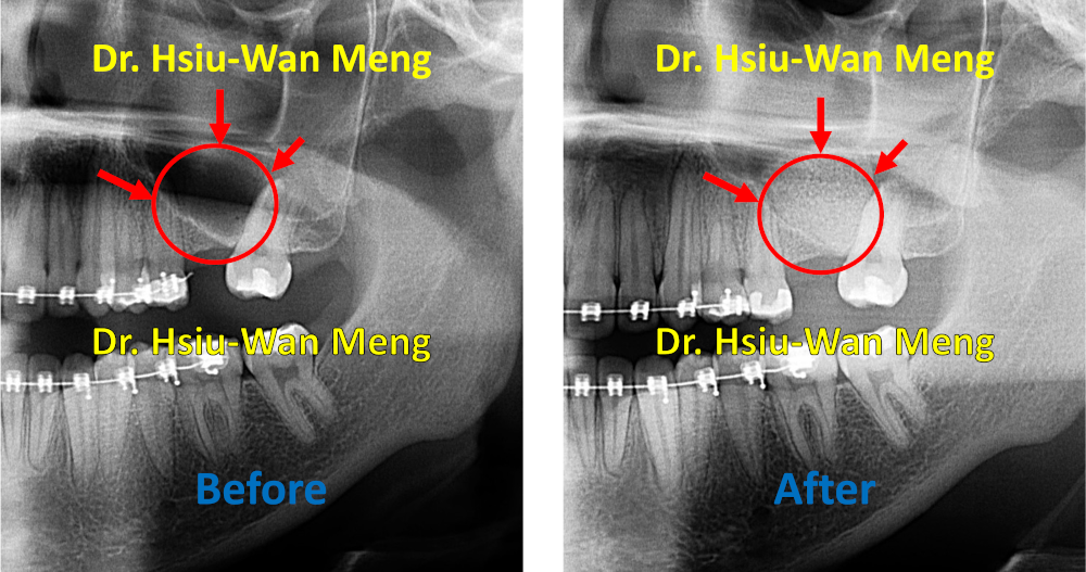 Sinus Bone Grafting 2