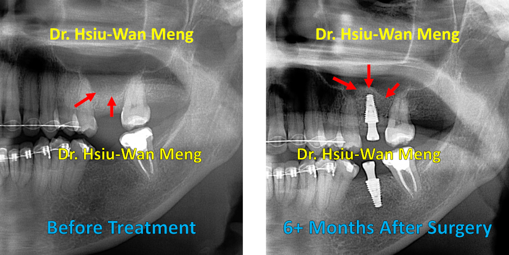 Sinus Bone Grafting Immediate Implant