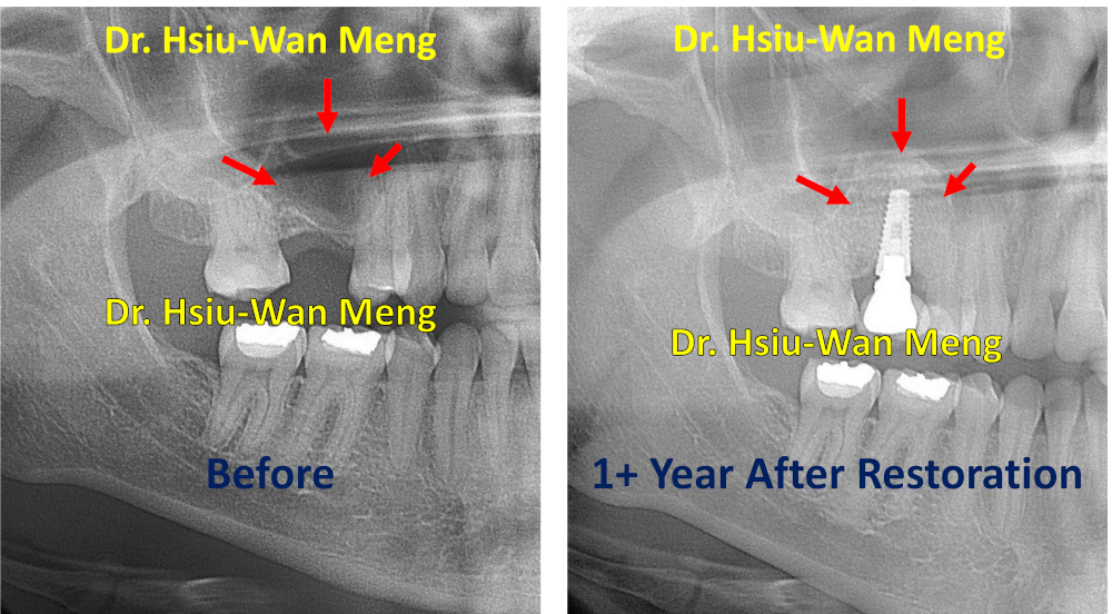 Sinus Bone Grafting Implant Restoration 1