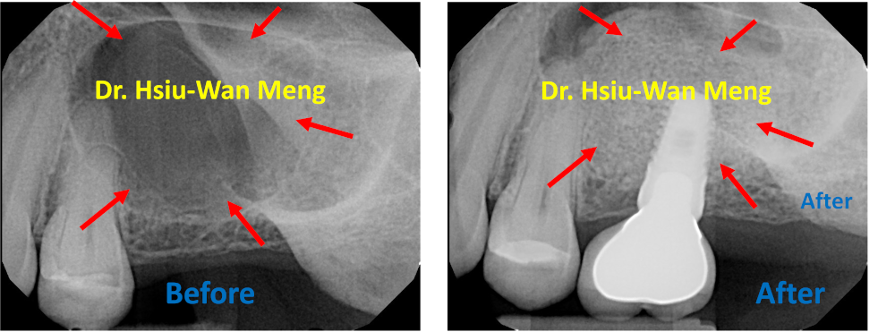 Sinus Bone Grafting Implant Restoration 2