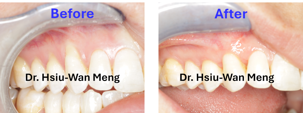 gum graft