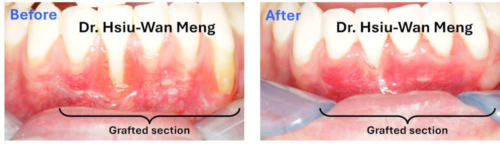 Gum Graft 2